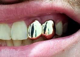 Custom Fit grillz  2 Teeth Gold Grillz fangs / 925 Silver Slugs Grillz , grillz with fangs / Vampire grillz with free mold kit free shipping - GrillzCity 